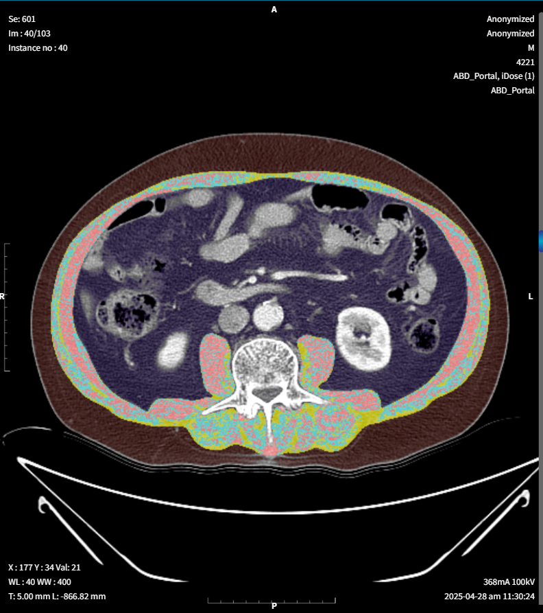 근육 지방 분석